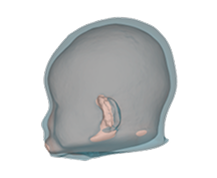 Brachycephaly before correction side view