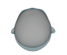 Brachycephaly before correction top view