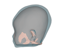 Brachycephaly before correction side view