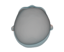 Combination brachycephaly and plagiocephaly top view