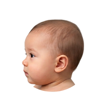 Mild brachycephaly