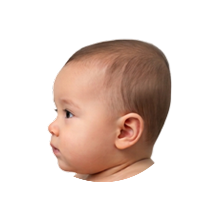 Moderate brachycephaly