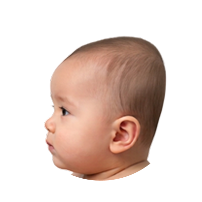 Severe brachycephaly