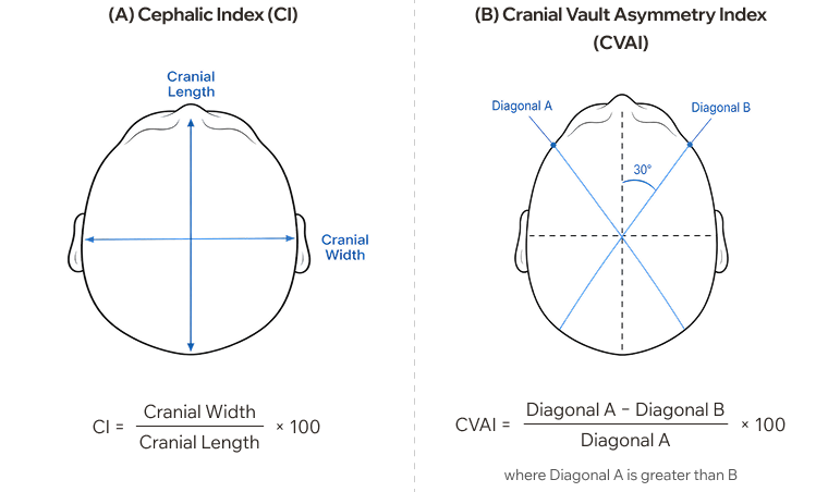 Cephalic Index (CI) and Cranial Vault Asymmetry Index (CVAI) measurement methods