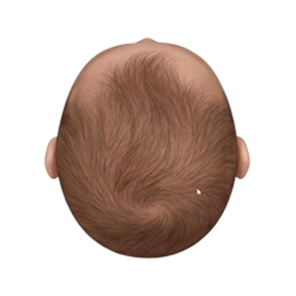 Normal plagiocephaly