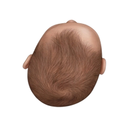 Severe plagiocephaly